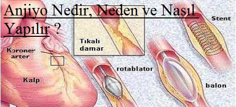 Anjiyo Nedir, Neden ve Nasıl Yapılır ?