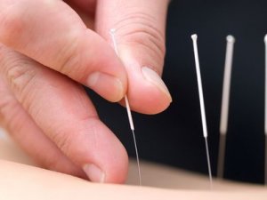 DevaPark Hastanesinde Akupunktur tedavisi başladı